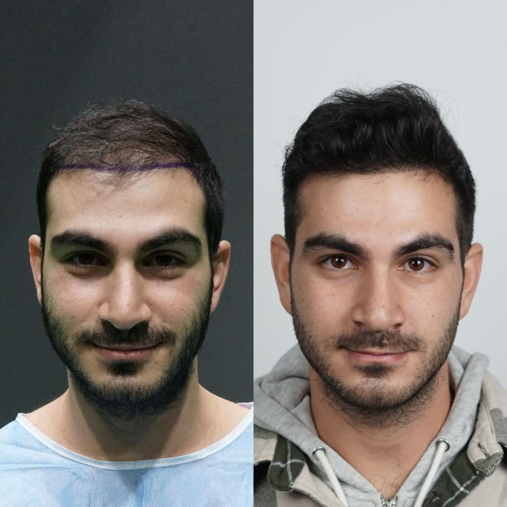 prima e dopo trapianto capelli 14